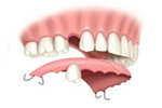 Removable Partial Denture in Medford, OR